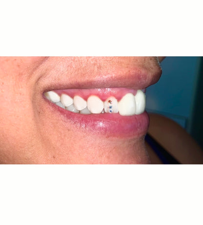 Virtual Tooth Gem Training w/ A Kit